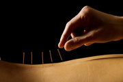 Acupuncture Treatment