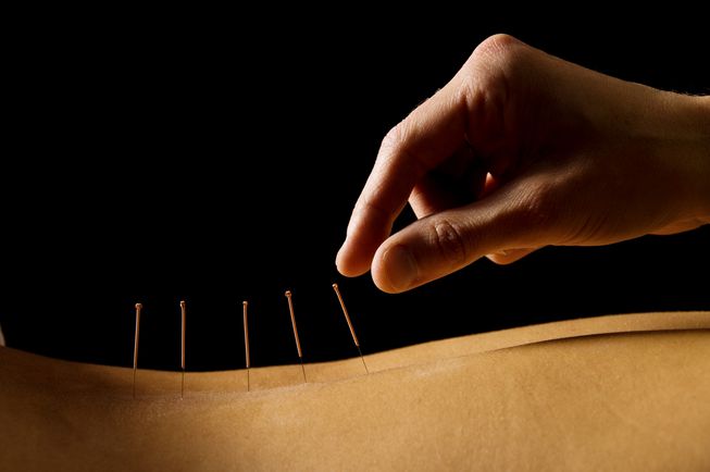 Acupuncture Treatment